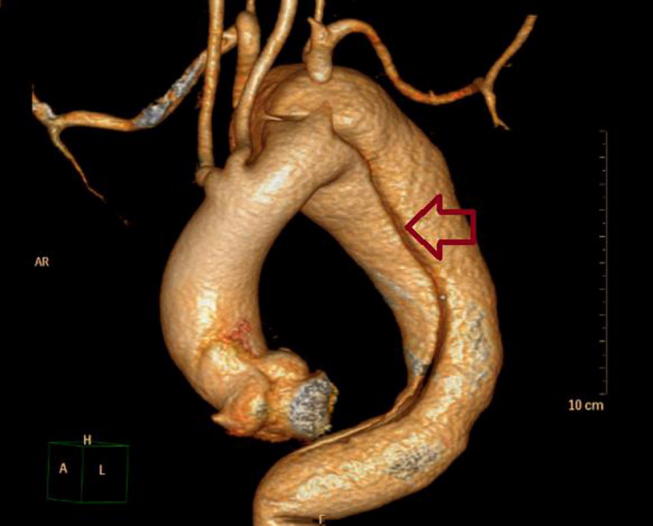 Short term outcome of thoracic endovascular aortic repair in patients with thoracic aortic diseases