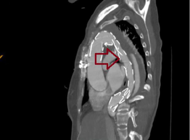 Short term outcome of thoracic endovascular aortic repair in patients with thoracic aortic diseases