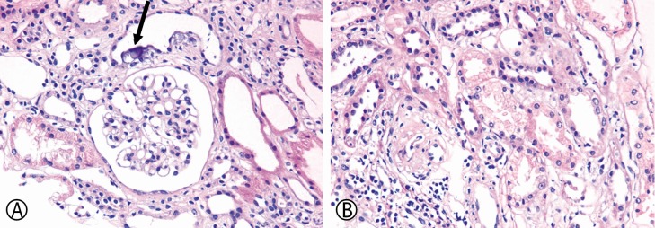 Interstitial Nephritis Caused by Anorexia Nervosa in Young Male; A Case Report and Literature Review.