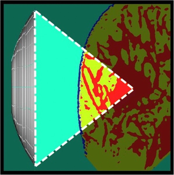 Effects of breast structure on high-intensity focused ultrasound focal error.