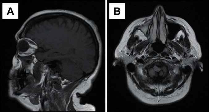 Diffusion-Weighted Magnetic Resonance Imaging in Maxillary Sinuses Inflammatory Diseases: Report of Three Cases and Literature Review.