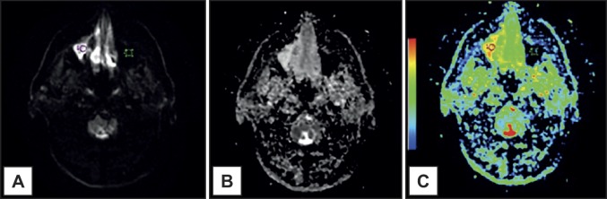 Diffusion-Weighted Magnetic Resonance Imaging in Maxillary Sinuses Inflammatory Diseases: Report of Three Cases and Literature Review.