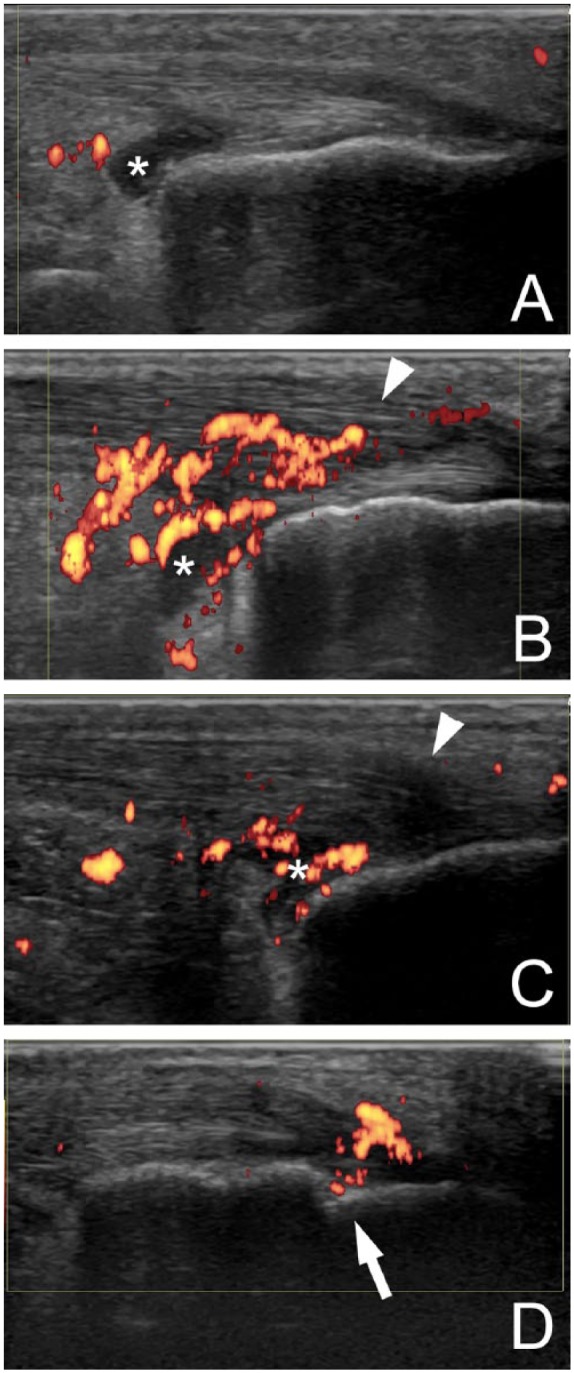 Retrocalcaneal Bursitis Precedes or Accompanies Achilles Tendon Enthesitis in the Early Phase of Rheumatoid Arthritis.