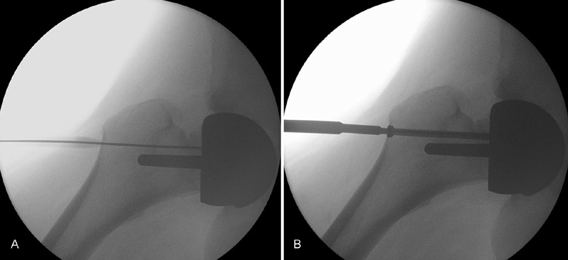 Stress Fracture of Proximal Femur after Hip Resurfacing Treated with Cannulated Screw.