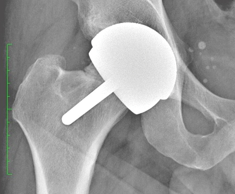 Stress Fracture of Proximal Femur after Hip Resurfacing Treated with Cannulated Screw.