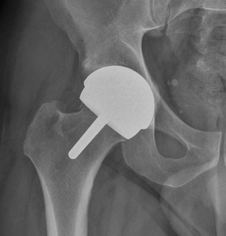 Stress Fracture of Proximal Femur after Hip Resurfacing Treated with Cannulated Screw.