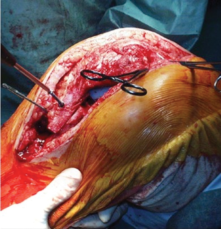 Tibial Tubercle Osteotomy in Total Knee Arthroplasty: Midterm Results Experience of a Monocentric Study.