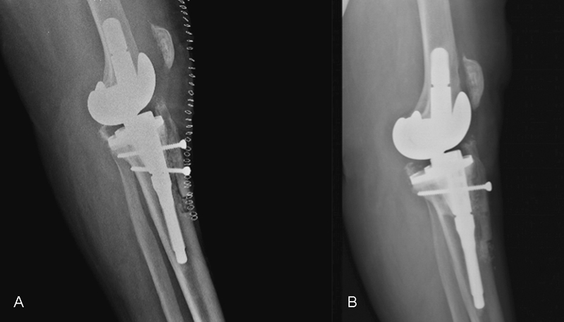 Tibial Tubercle Osteotomy in Total Knee Arthroplasty: Midterm Results Experience of a Monocentric Study.