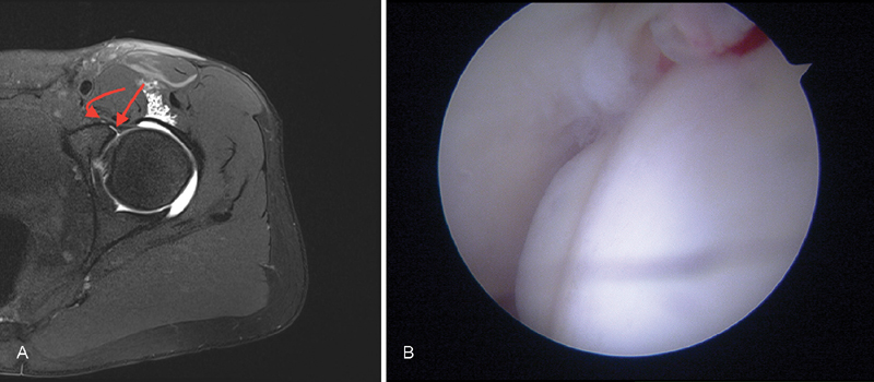 Diagnostic Accuracy of Magnetic Resonance Arthrography in Detecting Intra-articular Pathology Associated with Femoroacetabular Impingement.