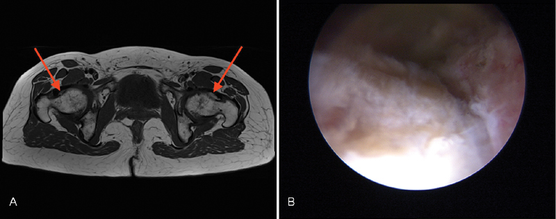 Diagnostic Accuracy of Magnetic Resonance Arthrography in Detecting Intra-articular Pathology Associated with Femoroacetabular Impingement.