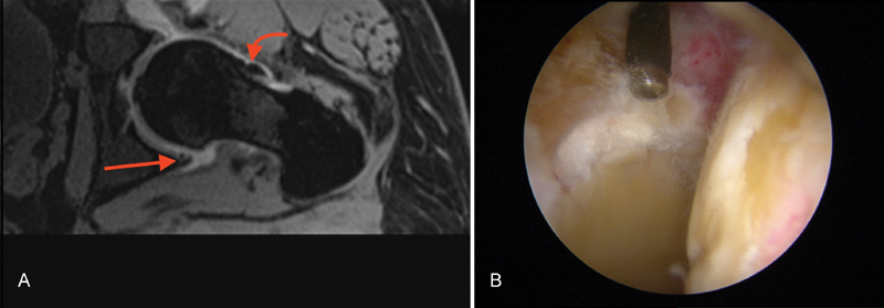 Diagnostic Accuracy of Magnetic Resonance Arthrography in Detecting Intra-articular Pathology Associated with Femoroacetabular Impingement.