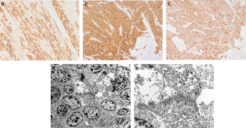 Contribution of Human papillomavirus in neuroendocrine tumors from a series of 10,575 invasive cervical cancer cases