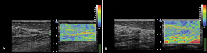 Can Elastosonography Be Useful in Improving Diagnosis and Prognosis of Acute Muscle Injuries?