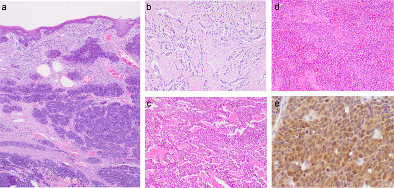 Contribution of Human papillomavirus in neuroendocrine tumors from a series of 10,575 invasive cervical cancer cases