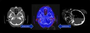 Application of 3D image fusion for radiological identification of decedents