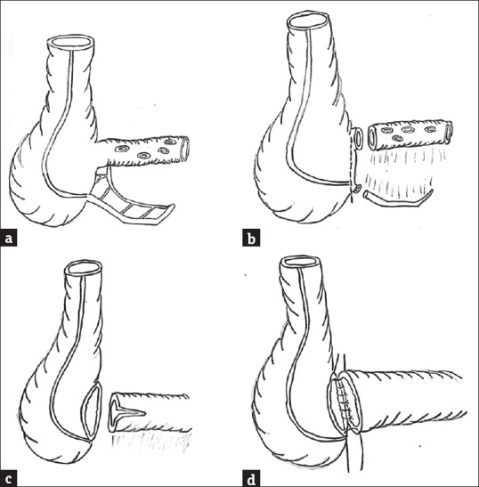 Emergency Ileo-cecal Anastomosis with Inclusion of Appendicular Stump in Terminal Ileal Pathology: A Newer Approach.