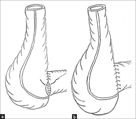 Emergency Ileo-cecal Anastomosis with Inclusion of Appendicular Stump in Terminal Ileal Pathology: A Newer Approach.