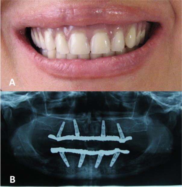 Full Arch All-on-4 Fixed Implant-Supported Prostheses with 8.5 Years of Follow-Up: A Case Report.