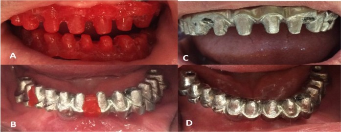 Full Arch All-on-4 Fixed Implant-Supported Prostheses with 8.5 Years of Follow-Up: A Case Report.