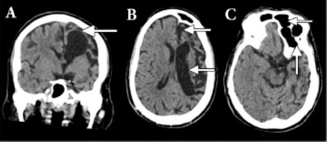 An unusual presentation of Dyke-Davidoff Masson syndrome.