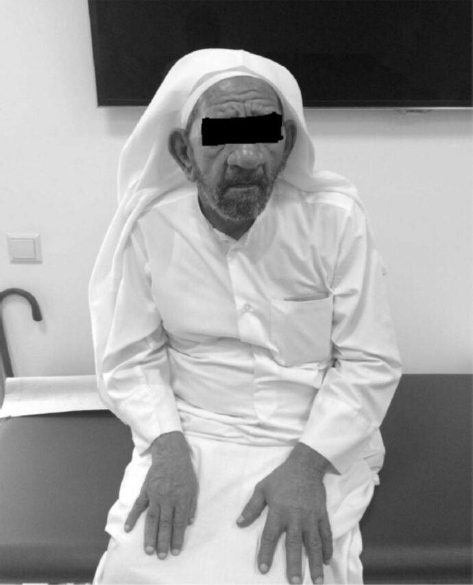 An unusual presentation of Dyke-Davidoff Masson syndrome.