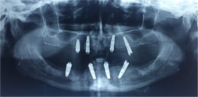 Full Arch All-on-4 Fixed Implant-Supported Prostheses with 8.5 Years of Follow-Up: A Case Report.