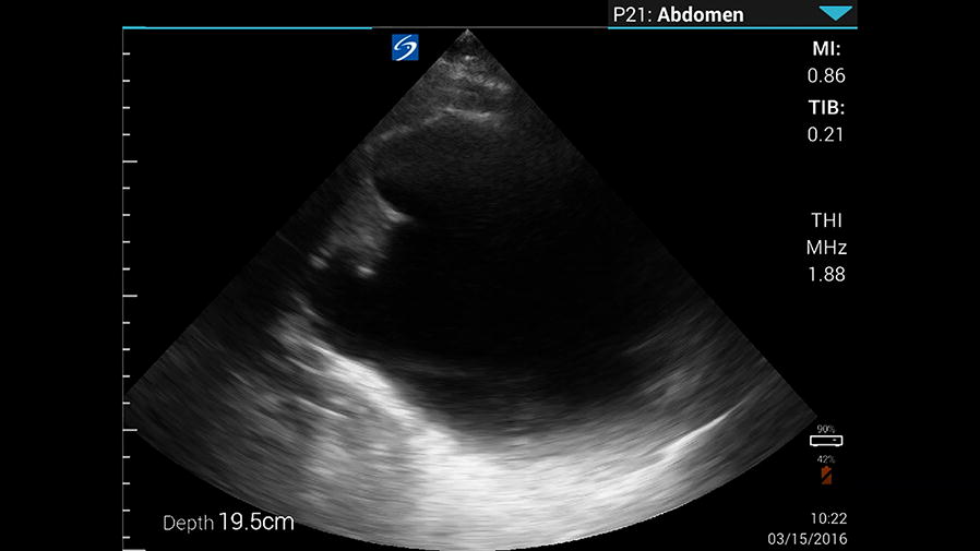 Icterus and abdominal pain: an unexpected, rare sonographic finding in a Peruvian Emergency Department.