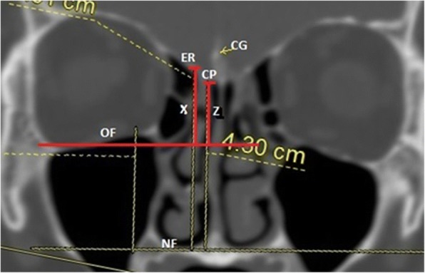 Is orbital floor a reliable and useful surgical landmark in endoscopic endonasal surgery?: a systematic review.