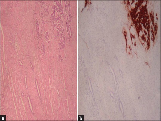 Mixed Adenoneuroendocrine Carcinoma of the Esophagus: A Case Report and Review of the Literature.