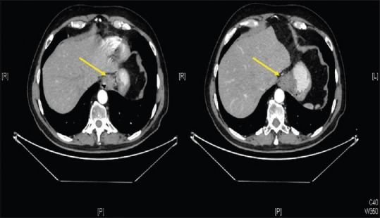 Mixed Adenoneuroendocrine Carcinoma of the Esophagus: A Case Report and Review of the Literature.