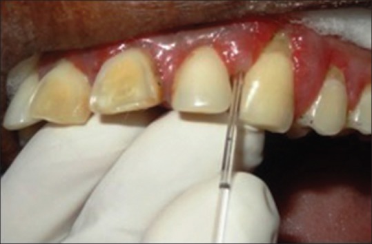 Influence of Smoking on Gingival Crevicular Fluid Interleukin 1β and Interleukin-8 in Patients with Severe Chronic Periodontitis among a Rural Population in India.