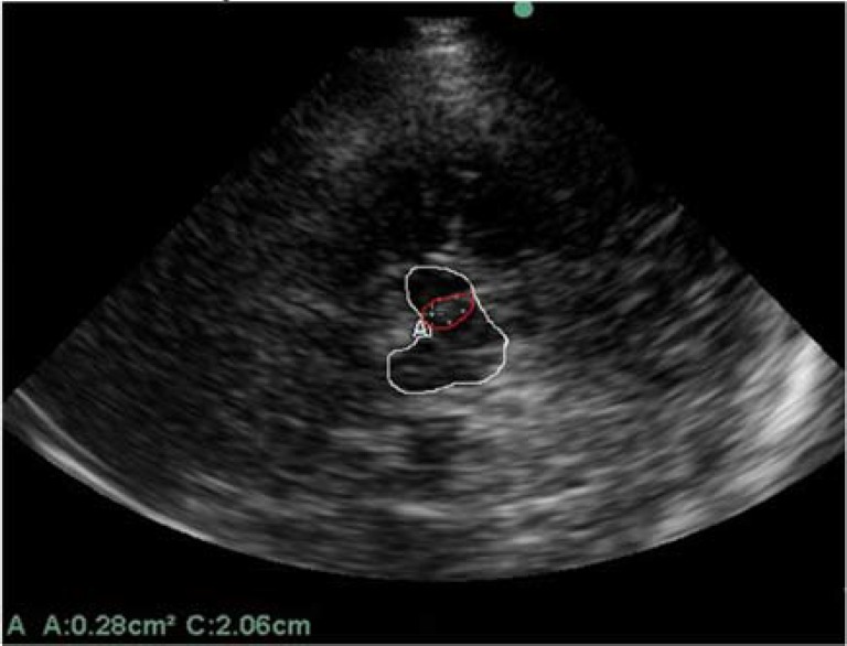 Transcranial sonography in carriers of Gaucher disease.