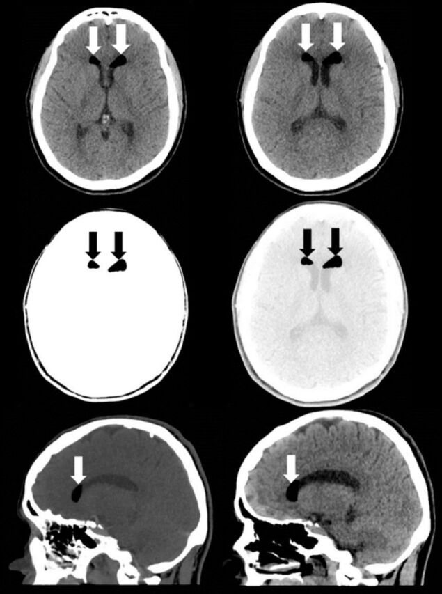Post-partum headache caused by dual pathology: A message to the anesthetist.