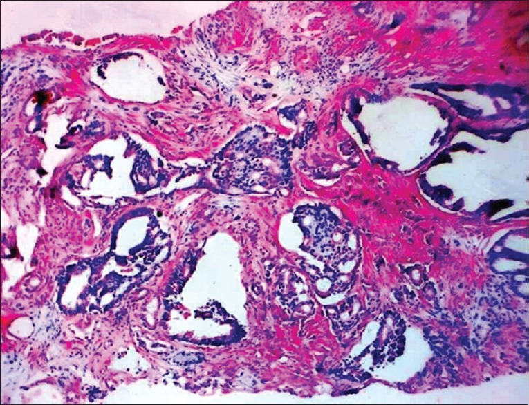 Unsuspected Skin Metastasis of Adenocarcinoma of the Prostate in a Patient on Goserelin (Zoladex).