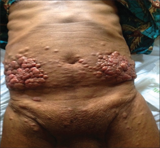 Unsuspected Skin Metastasis of Adenocarcinoma of the Prostate in a Patient on Goserelin (Zoladex).