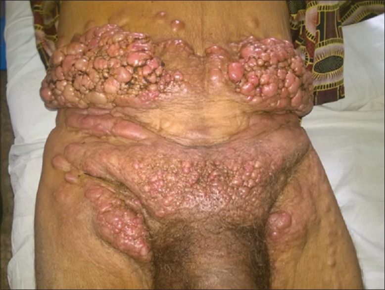 Unsuspected Skin Metastasis of Adenocarcinoma of the Prostate in a Patient on Goserelin (Zoladex).