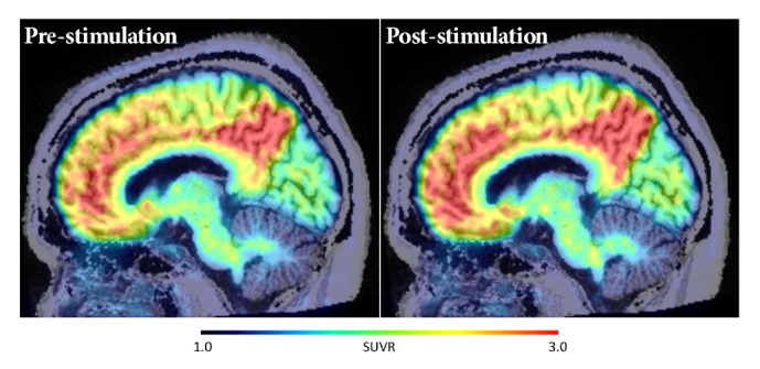 The Effect of 40-Hz Light Therapy on Amyloid Load in Patients with Prodromal and Clinical Alzheimer's Disease.