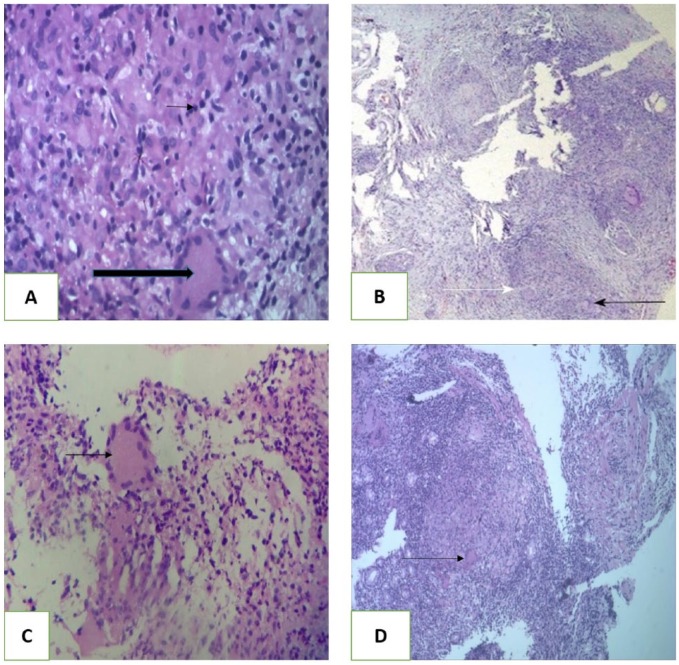 Gastroduodenal Tuberculosis: A Case Series and Review of Literature.