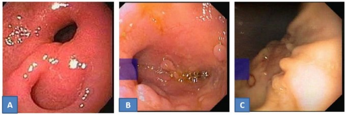 Gastroduodenal Tuberculosis: A Case Series and Review of Literature.