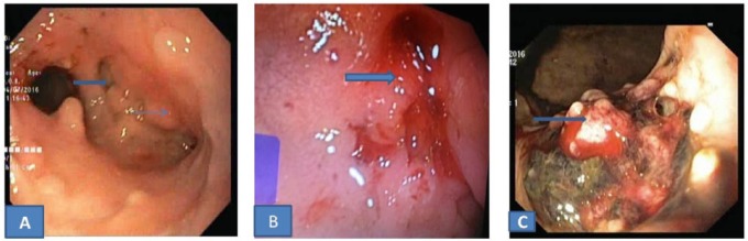 Gastroduodenal Tuberculosis: A Case Series and Review of Literature.