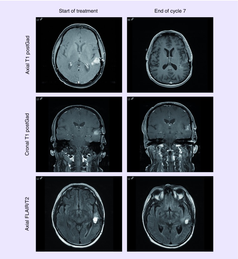 Phase II study of ERC1671 plus bevacizumab versus bevacizumab plus placebo in recurrent glioblastoma: interim results and correlations with CD4<sup>+</sup> T-lymphocyte counts.