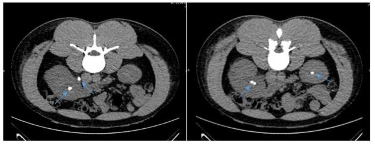 Nontypable <i>Haemophilus influenzae</i> Septicemia and Urinary Tract Infection Associated with Renal Stone Disease.