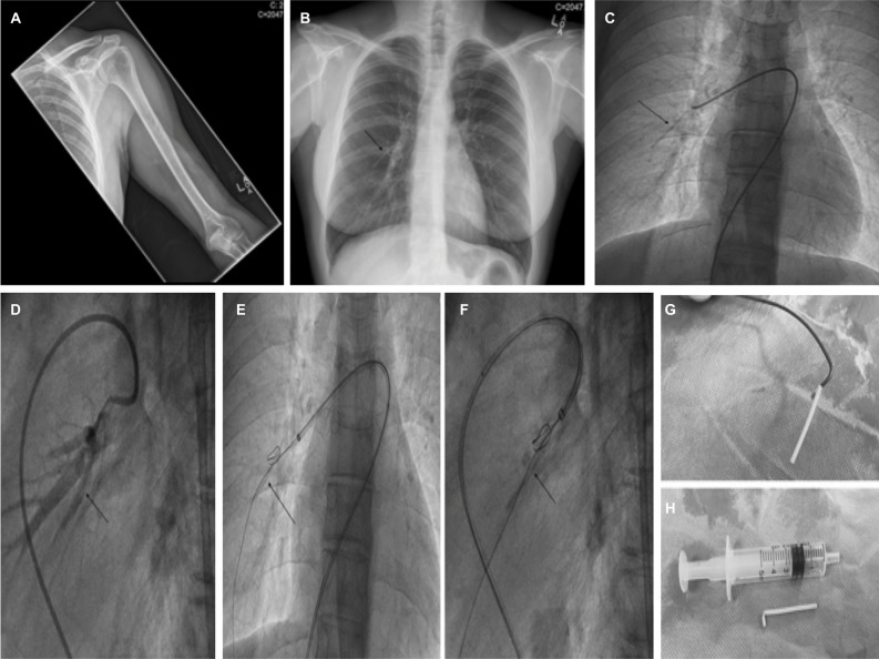 Percutaneous extraction of an embolized progesterone contraceptive implant from the pulmonary artery.