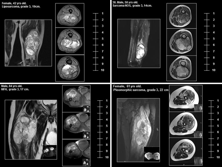 Regional chemotherapy by isolated limb perfusion prior to surgery compared with surgery and post-operative radiotherapy for primary, locally advanced extremity sarcoma: a comparison of matched cohorts.