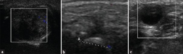 Efficiency of Ultrasonography in Swellings of Orofacial Region.