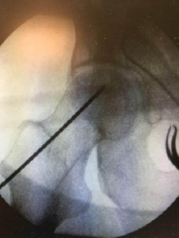 What is the role of core decompression in the early stages of osteonecrosis of the femoral head? Evaluation of the surgical result by functional score and radiological follow-up