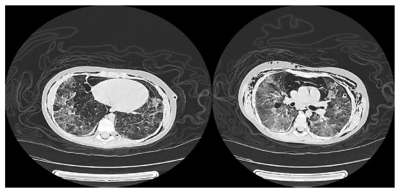 Severe Allergic Bronchopulmonary Mycosis and Long-Term Follow-Up.