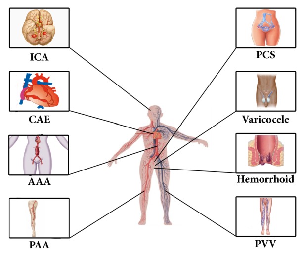 Dilating Vascular Diseases: Pathophysiology and Clinical Aspects.