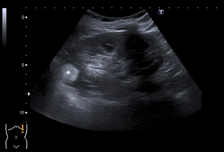 Diagnostic Imaging for Solid Renal Tumors: A Pictorial Review.