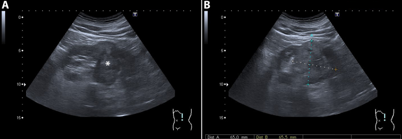 Diagnostic Imaging for Solid Renal Tumors: A Pictorial Review.